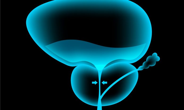 Hiperplasia de próstata Goiânia -Conheça 5 fatores de risco para o aumento da próstata
