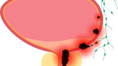 Tratamento de câncer de bexiga Goiânia - Mitos e verdades sobre o câncer de bexiga