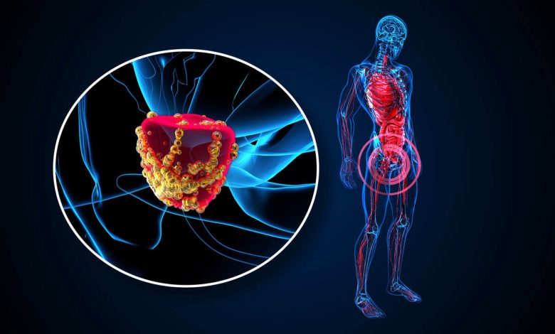 Já ouviu falar sobre Prostatectomia Robótica?