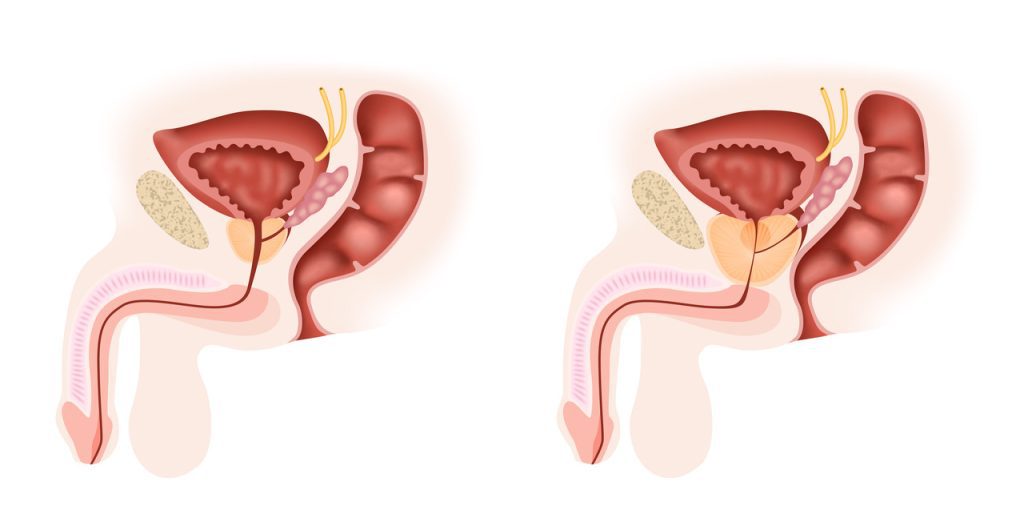 Enucleação endoscópica da próstata: o que é e em que casos essa técnica é utilizada!