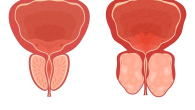 REZUM ou HoLEP? Qual a melhor cirurgia para a hiperplasia prostática benigna (HPB)?