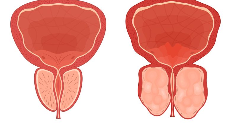 REZUM ou HoLEP? Qual a melhor cirurgia para a hiperplasia prostática benigna (HPB)?