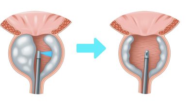Enucleação da próstata: conheça os benefícios para tratar HPB