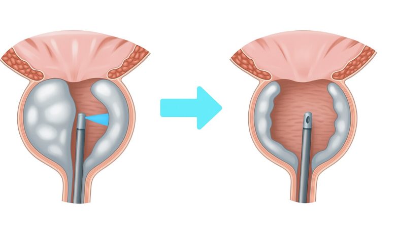 Enucleação da próstata: conheça os benefícios para tratar HPB
