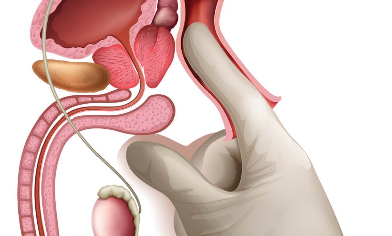 Exame de toque: porque este exame é essencial no diagnóstico precoce do câncer de próstata