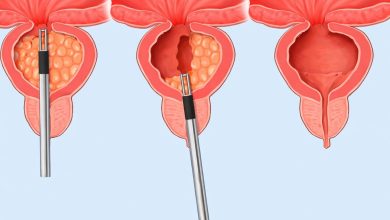 Qual a Diferença entre a Raspagem da Próstata e a Cirurgia a Laser