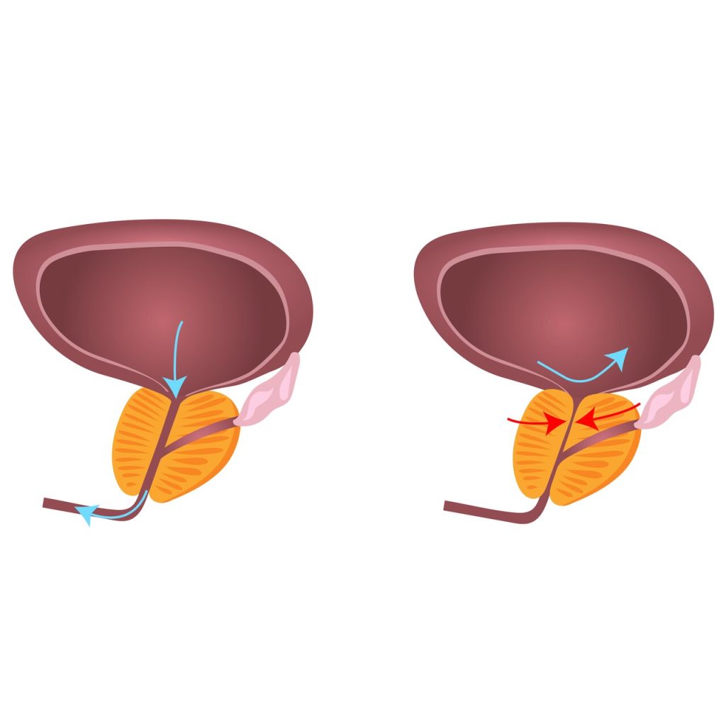 Enucleação Endoscópica Prostática com Laser em que caso esta técnica é utilizada