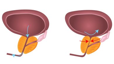 Enucleação Endoscópica Prostática com Laser em que caso esta técnica é utilizada