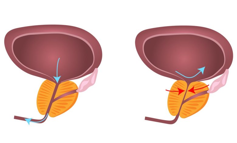 Enucleação Endoscópica Prostática com Laser em que caso esta técnica é utilizada