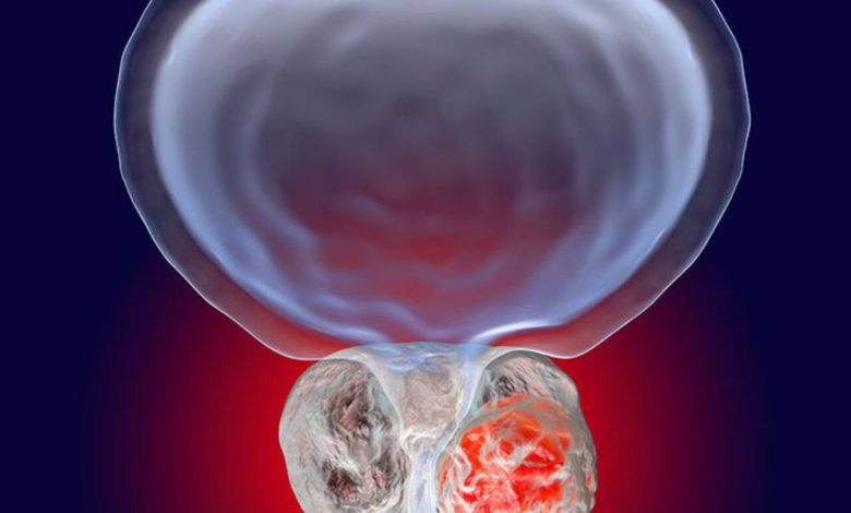 Câncer de próstata: por que cada vez mais pacientes optam pela cirurgia robótica?