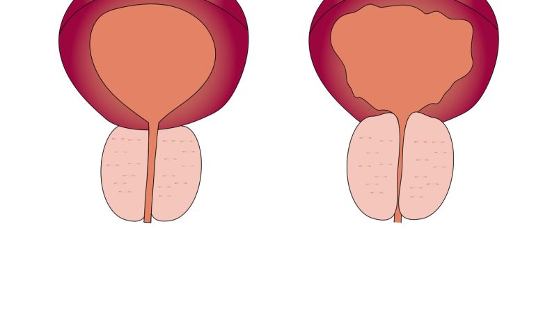Cirurgia a laser está mudando o tratamento da próstata aumentada